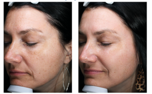 HALO Laser Before and After - Blush Aesthetics