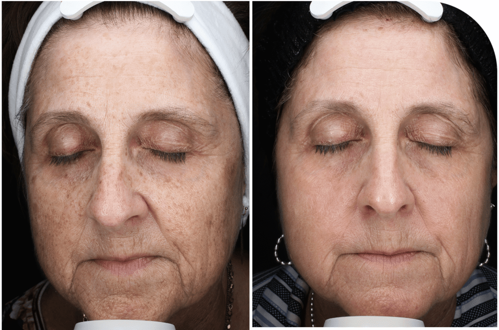 before and after of client after receiving moxi treatment