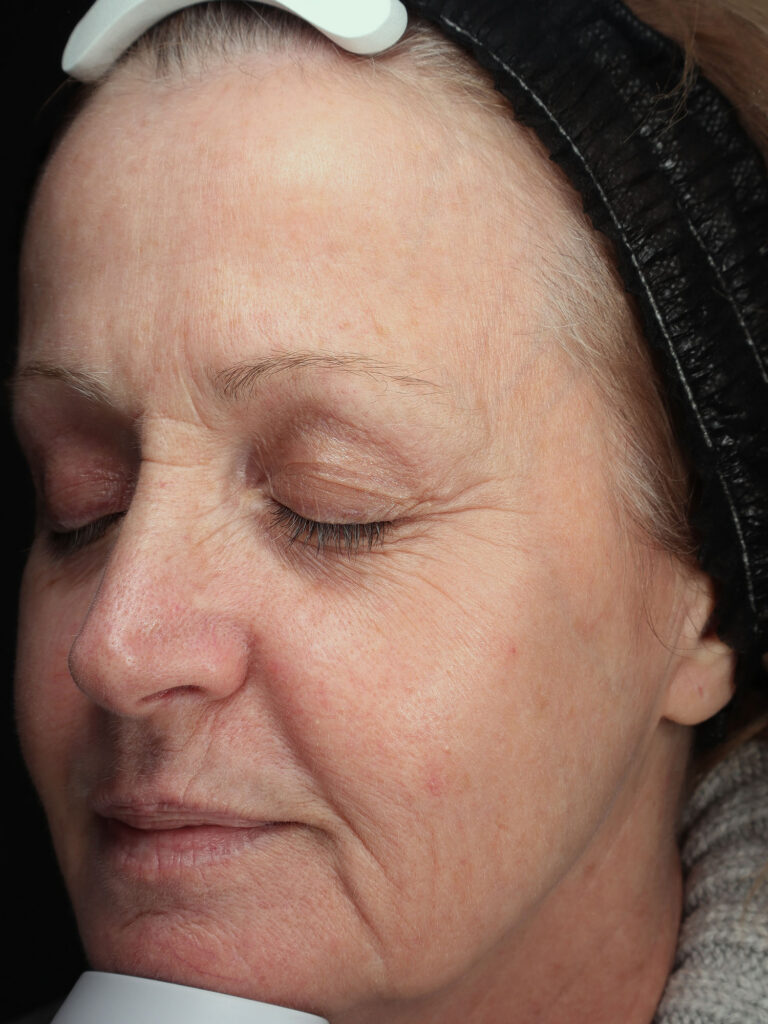 Before and after results of a Halo Laser and BBL combo treatment for skin rejuvenation at Blush Aesthetics medspa in Toledo and Columbus