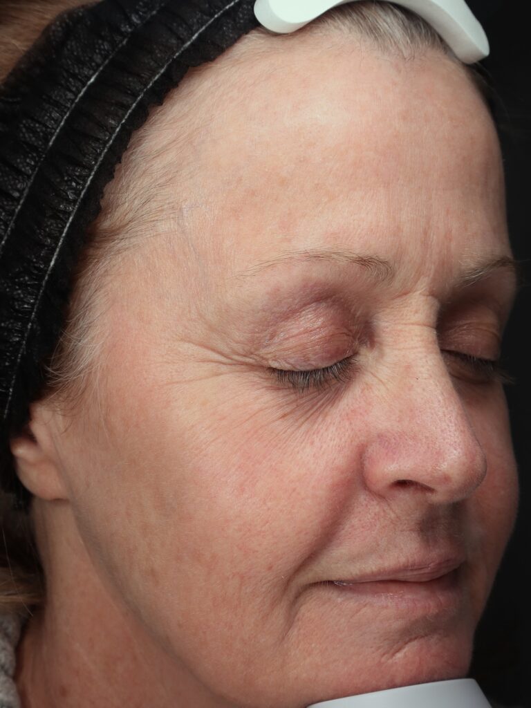 Before and after results of a Halo Laser and BBL combo treatment for skin rejuvenation at Blush Aesthetics medspa in Maumee and New Albany