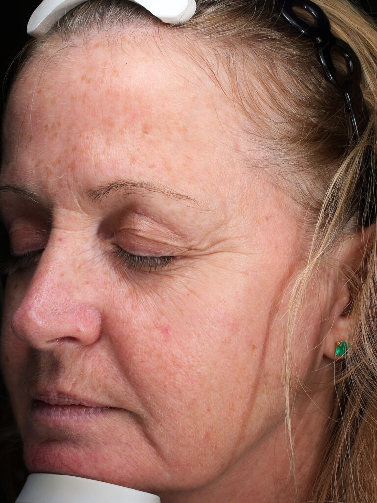 Before and after results of a Halo Laser and BBL combo treatment for skin rejuvenation at Blush Aesthetics medspa in Toledo and Columbus