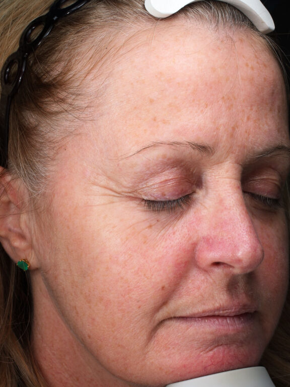 Before and after results of a Halo Laser and BBL combo treatment for skin rejuvenation at Blush Aesthetics medspa in Maumee and New Albany