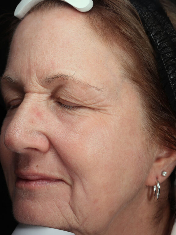 Before and after results of a Halo Laser and BBL combo treatment for sun damage in Toledo and Columbus at Blush Aesthetics medspa