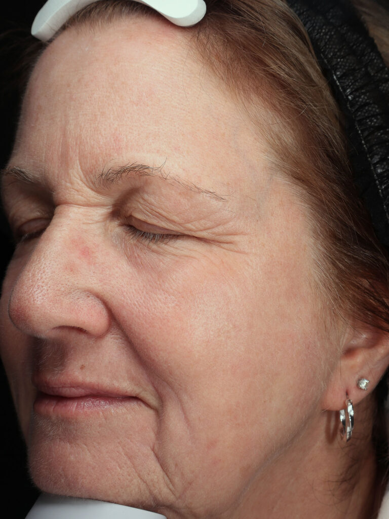 Before and after results of a Halo Laser and BBL combo treatment for sun damage in Toledo and Columbus at Blush Aesthetics medspa