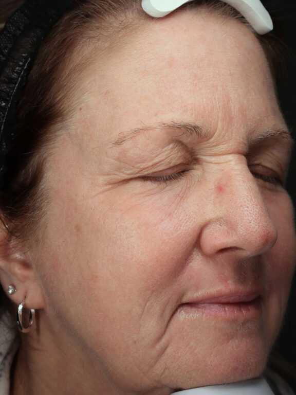 Before and after results of a Halo Laser and BBL combo treatment for sun damage at Blush Aesthetics medspa in Findlay and Galena