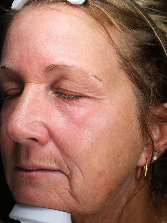 Before and after results of a Halo Laser and BBL combo treatment for sun damage in Toledo and Columbus at Blush Aesthetics medspa