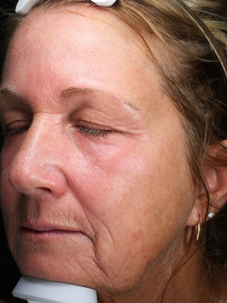 Before and after results of a Halo Laser and BBL combo treatment for sun damage in Toledo and Columbus at Blush Aesthetics medspa