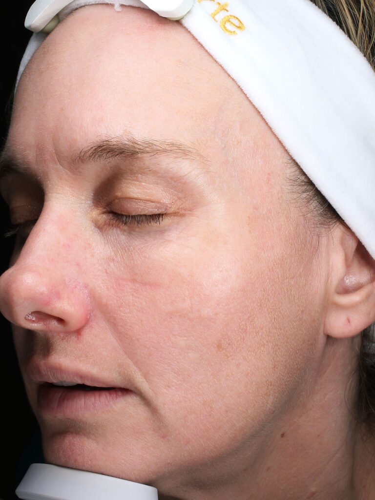 Before and after results of a BBL photo facial treatment for brown spots at Blush Aesthetics medspa in Maumee, Findlay,  New Albany and Upper Arlington