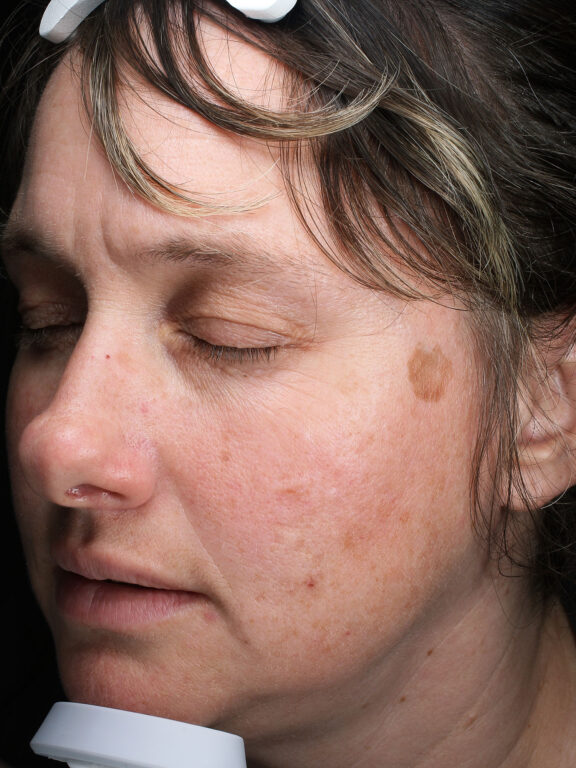 Before and after results of a BBL photo facial treatment for brown spots at Blush Aesthetics medspa in Maumee, Findlay,  New Albany and Upper Arlington