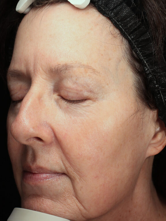 Before and after results of a BBL photo facial treatment for sun damage at Blush Aesthetics medspa in Maumee, Findlay, New Albany and Upper Arlington