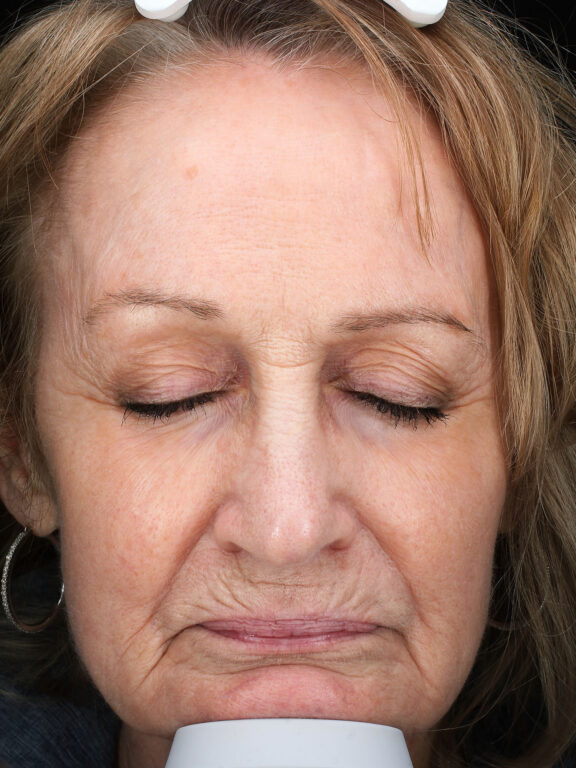 Before and after results of a laser resurfacing treatment for upper lip lines and smokers lines at Blush Aesthetics medspa in near Toledo, OH and Columbus, OH