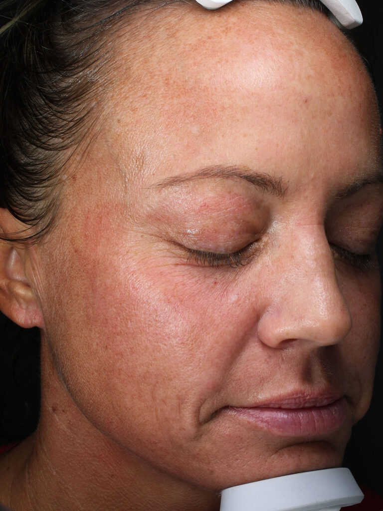 Before and after results of a Moxi Laser and BBL photo facial treatment for pigment at Blush Aesthetics medspa in Maumee, Findlay, New Albany and Upper Arlington