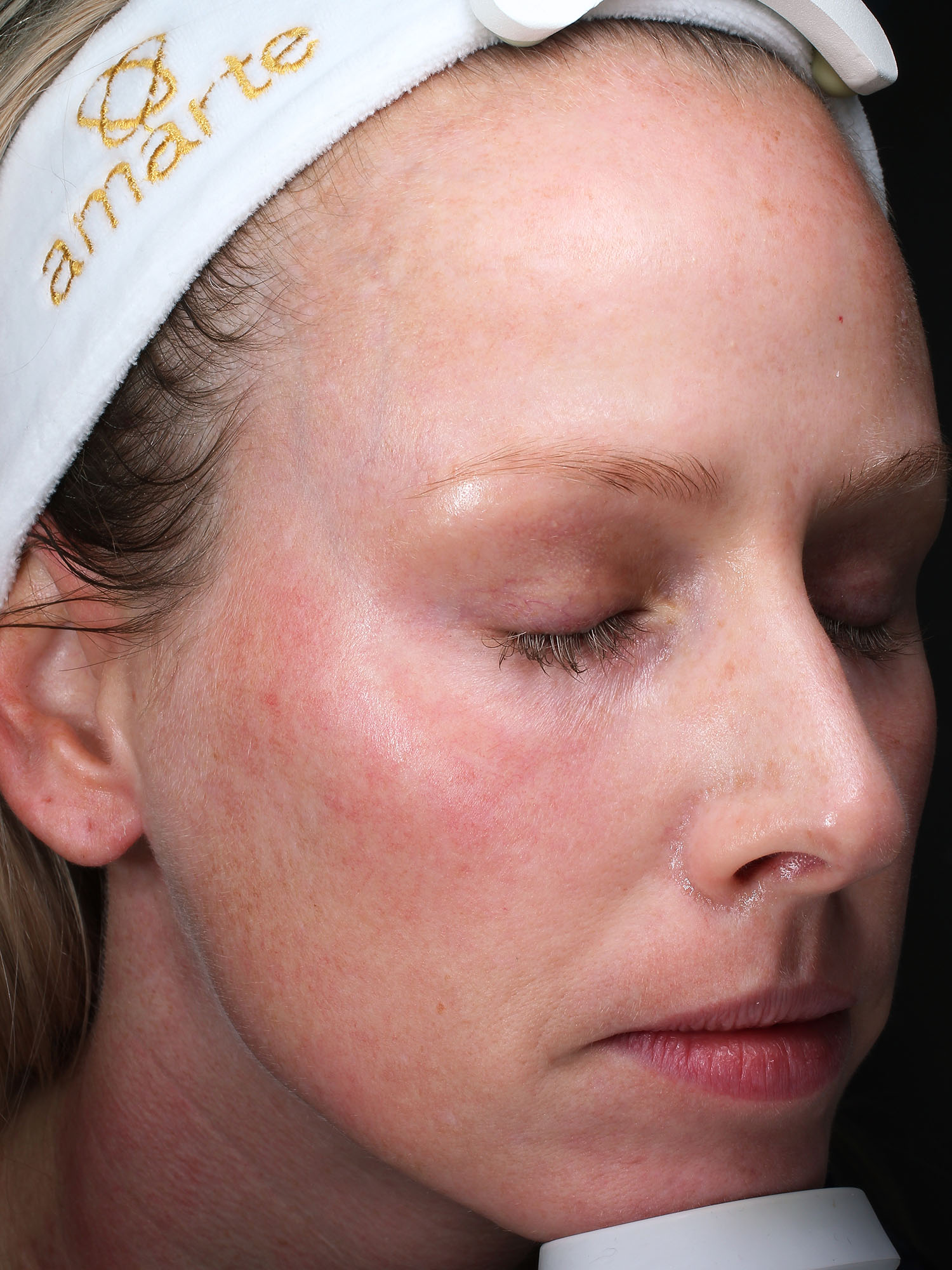 Before and after results of a Moxi Laser treatment for melasma at Blush Aesthetics medspa in Maumee, Findlay, New Albany and Upper Arlington