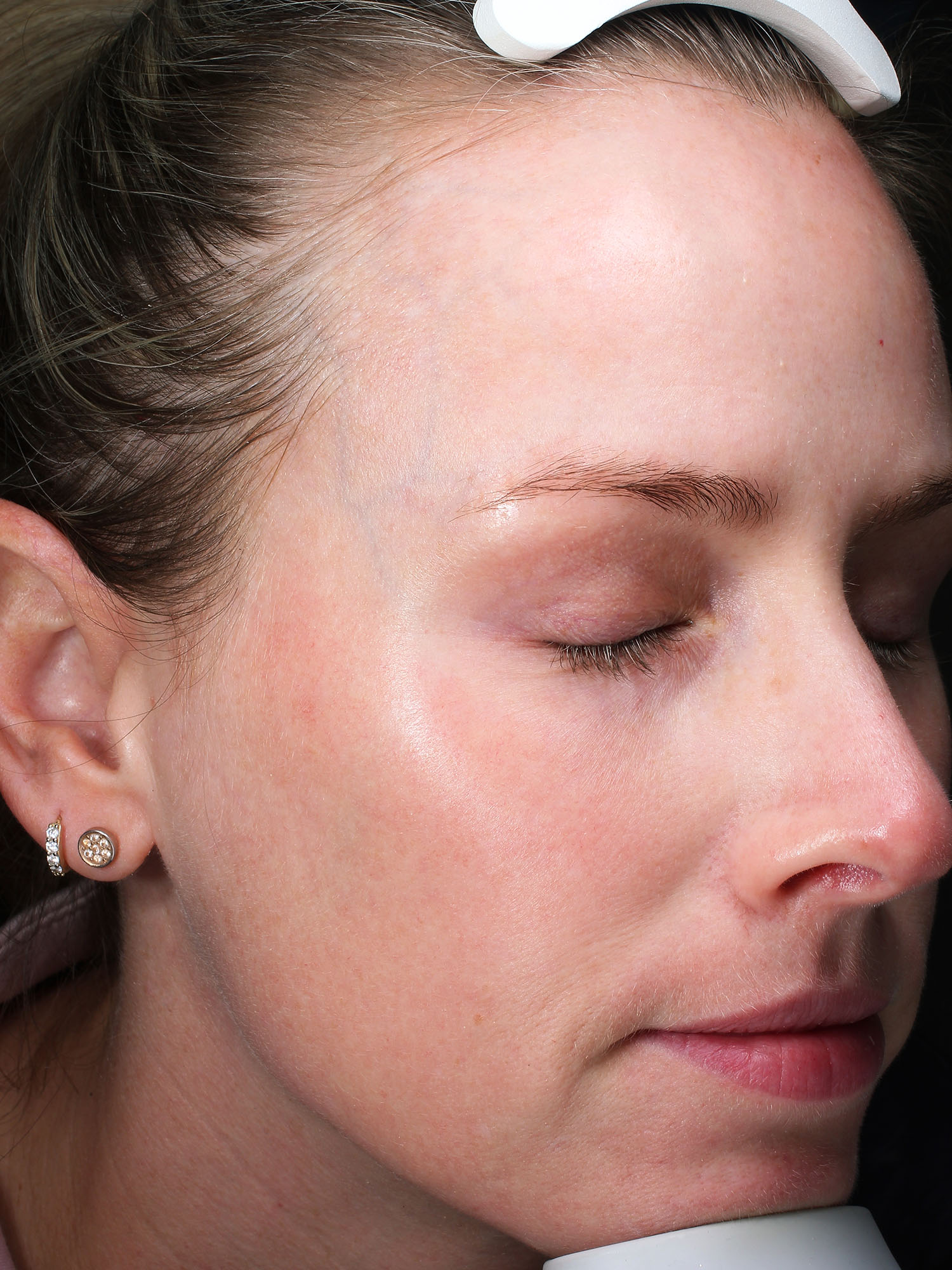 Before and after results of a Moxi Laser treatment for melasma at Blush Aesthetics medspa in Maumee, Findlay, New Albany and Upper Arlington